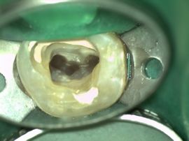 歯の中には一般的に「歯の神経」（「歯髄（しずい）」と呼ばれる軟かい組織）が入っています
